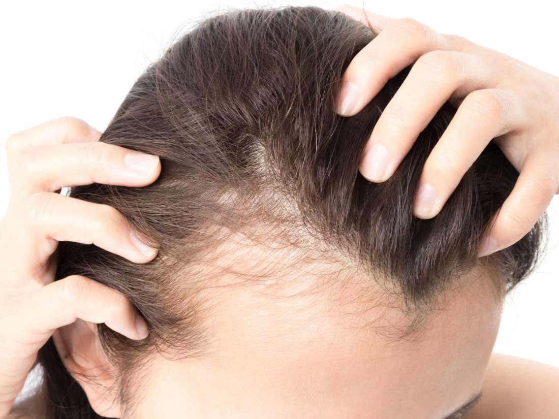 5 طرق بسيطة لاستعمال زيت الخروع لعلاج الصلع وتساقط الشعر 5 طرق بسيطة لاستعمال زيت الخروع لعلاج الصلع وتساقط الشعر